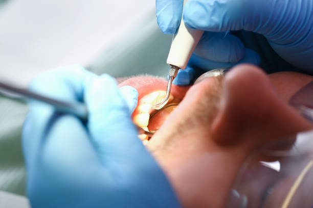 Best Dental Abscess Treatment in New Lexington, OH